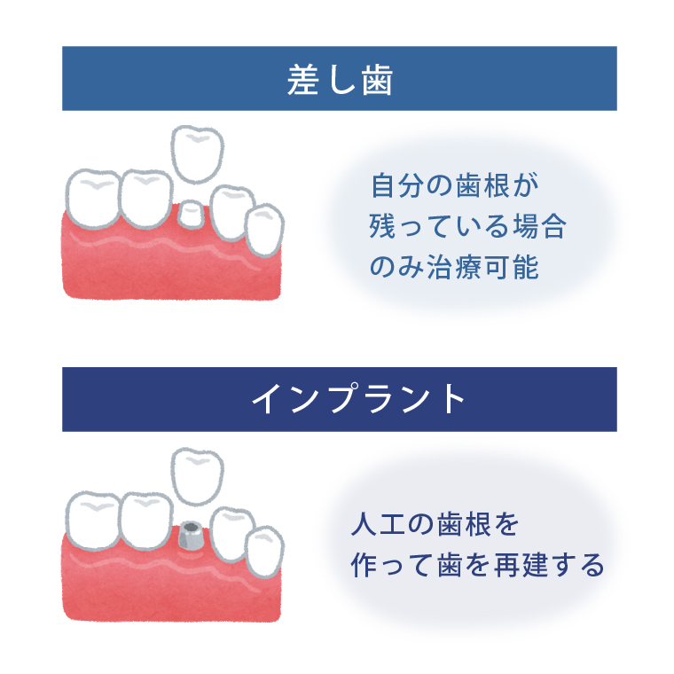 インプラントとは】差し歯との違い/安全な治療の為の歯科選び4ポイント